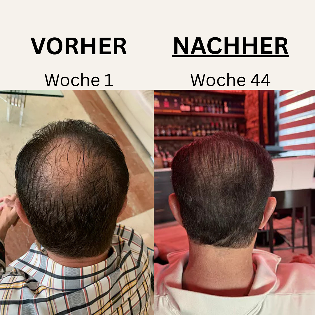 Bajyao PRO – Rotlicht-Therapie für volleres, gesünderes Haar! ©